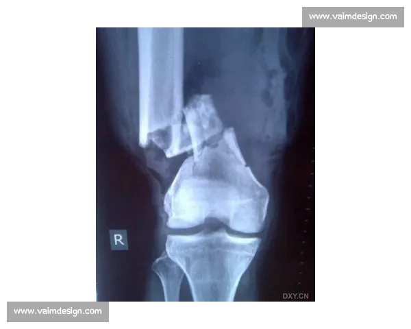 骨折恢复过程中的关键因素与科学治疗方法探讨 骨折恢复过程中的关键因素与科学治疗方法探讨